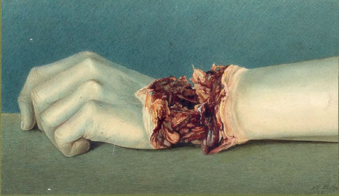 blackpaint20:

Shell wound of the wrist.
Medical Illustration by William Shultze, 1863.
