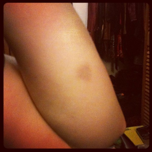arm bruise, origins unknown, portrait challenge #365