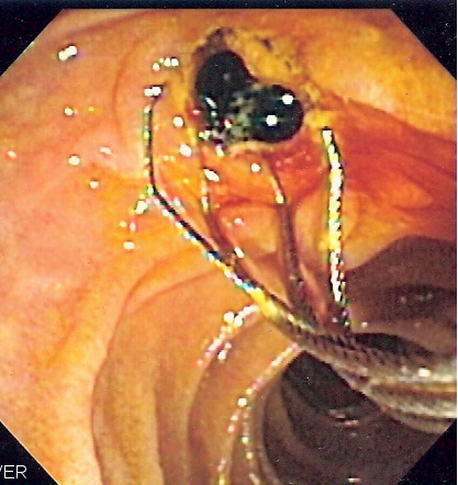common bile duct stone. Obstructed Common Bile Duct.