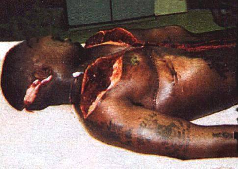 Tupac Shakur's dead body on the autopsy table.
