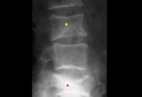Wedge Compression Fracture
