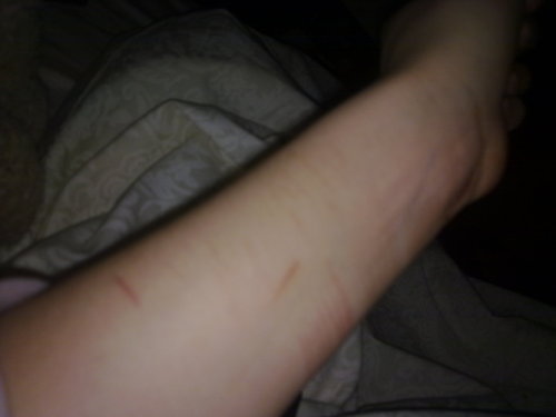 self injury wrist pics