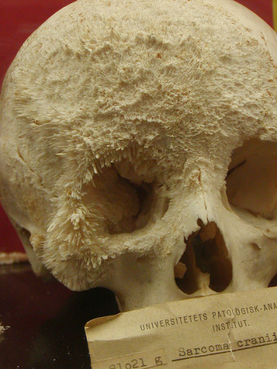 durianseeds: Кость рака на человеческий череп.  Как ни странно красивое.