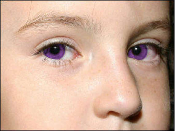 Complete Heterochromia Iridis