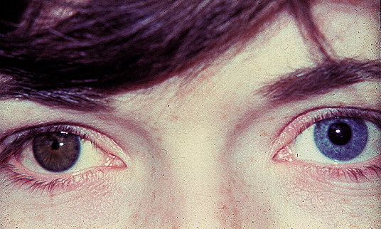 Eye Pupil Defects