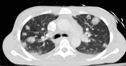 Septic emboli, pulmonary CT&#10;Often seen in IV drug users or immunocompromised patients with right sided bacterial endocarditis. Unhygienic IV drug use may inadvertently inject skin flora into the bloodstream which then seeds the tricuspid valve, shooting off emboli into the lungs. Physical exam may reveal a holosystolic murmur that increases in intensity with inspiration. Note the bilateral peripheral parenchymal nodules on lung CT.