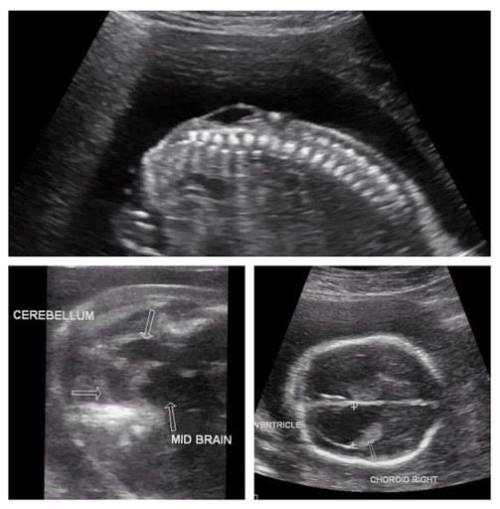 q-20-week-morphology-scan-what-is-the-diagnosis-what-two-radiopaedia