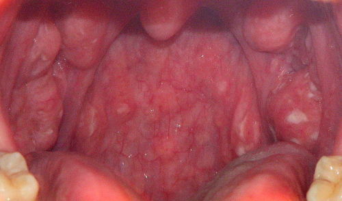 Candida yeast infection mouth