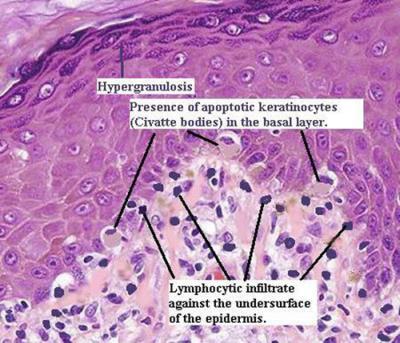 hypergranulosis